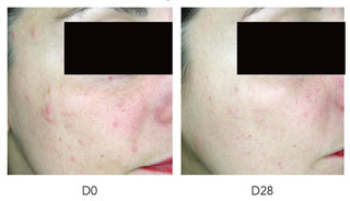 טיפים להתמודדות עם עור הנוטה לפצעונים: מה לעשות ואיך אפשר למנוע הופעה של פצעונים חדשים?